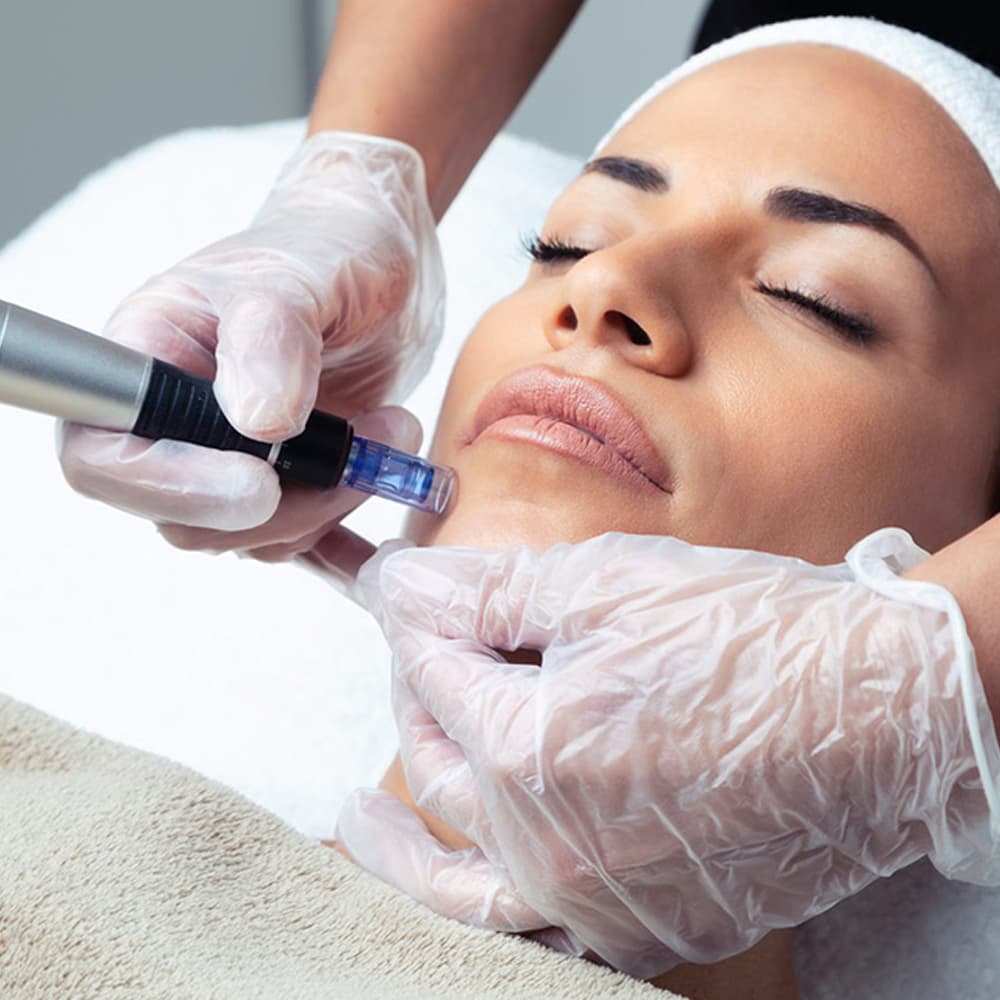 Зони проведення мікронідлінгу Dermapen