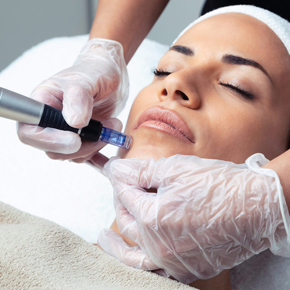 Зони проведення мікронідлінгу Dermapen